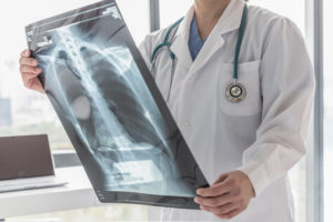 How an NYC Car Accident Lawyer Can Help You Pursue Compensation for Your Chest Injuries